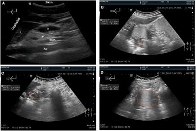 Gastric-filling ultrasonography to evaluate gastric motility in patients with Parkinson's disease